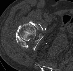 Acetabular Fracture Both Columns 1